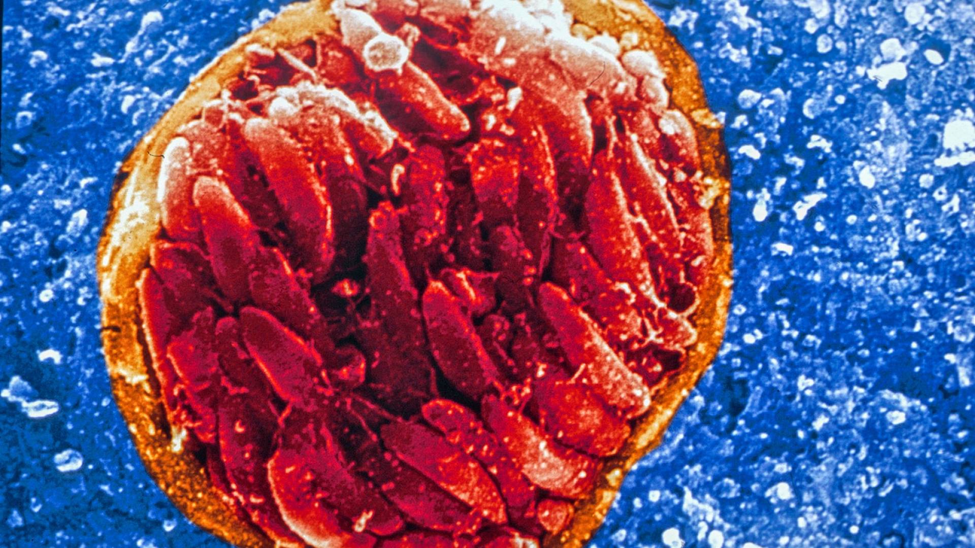 Tissue cyst in brain