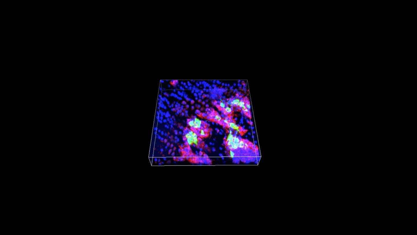 Red osteoblasts surrounding the green cancer cells in bone