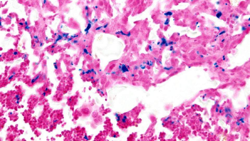 Cancer Cells through a microscope